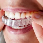 Invisalign: Redefining Teen Orthodontics with Clear Aligners